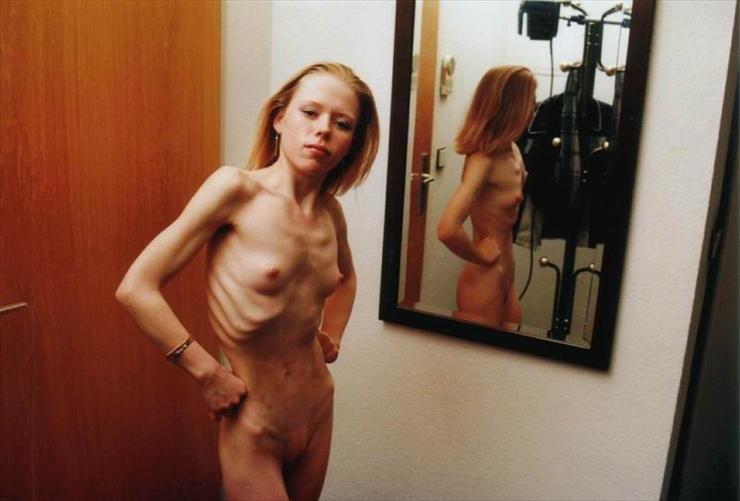 Anorexia - 13acbbff9748da7a.jpg