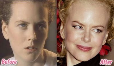 TURECKIE9 - Nicole Kidman - botox.jpg
